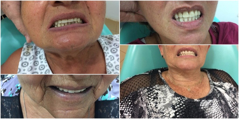 Prefeitura Municipal realizou nesta semana entrega de próteses dentárias em Deodápolis 