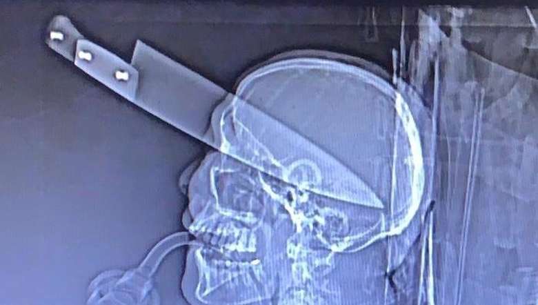 Homem morre após ter faca cravada no olho em Dourados