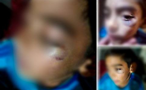 Mãe reclama de escola pública após filho de 9 anos voltar para casa com olho roxo
