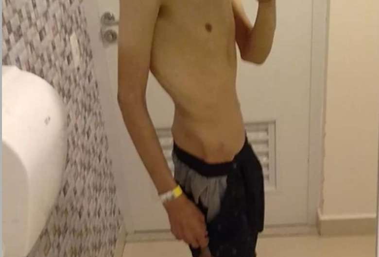 Atualmente o jovem enfrenta diversos problemas de saúde em decorrência da Bulimia e Anorexia - Crédito: Ligado a redação 