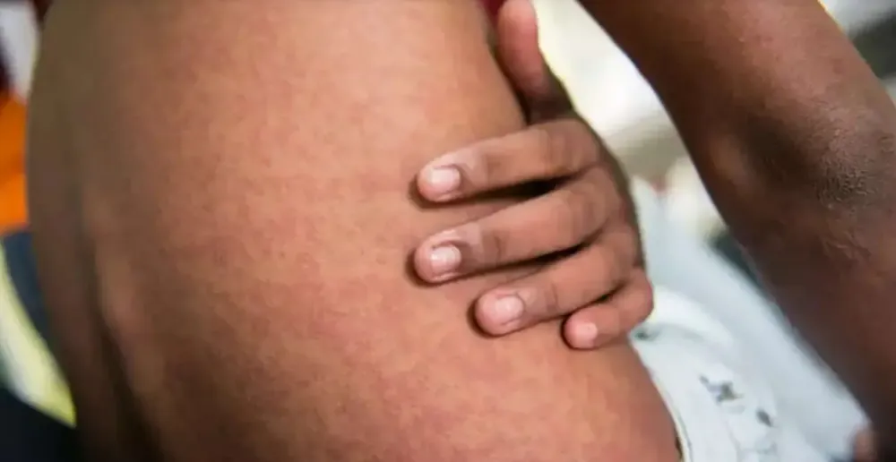 Novo boletim mostra que Dourados tem 74,5% dos casos positivos para chikungunya